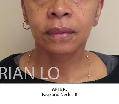 Face & Neck Lift — After