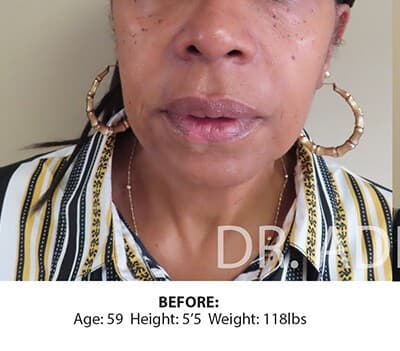 Face & Neck Lift — Before
